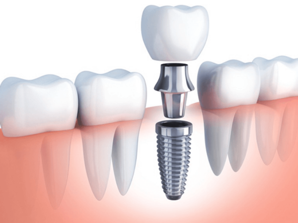 Cấy răng Implant là gì?