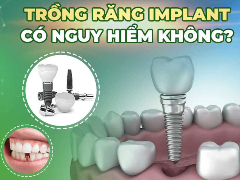 Cấy răng Implant có ảnh hưởng gì không? Có nguy hiểm không?