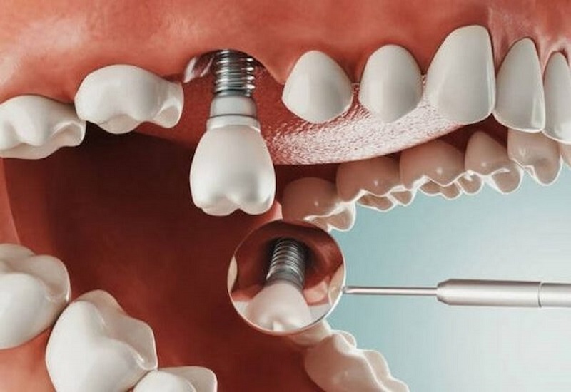 Trường hợp trồng răng Implant bị nhiễm trùng nặng