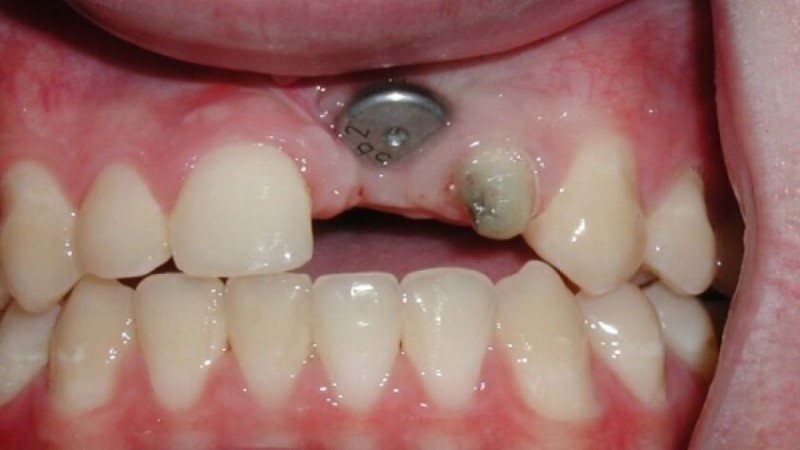 Nguyên nhân làm hỏng răng implant