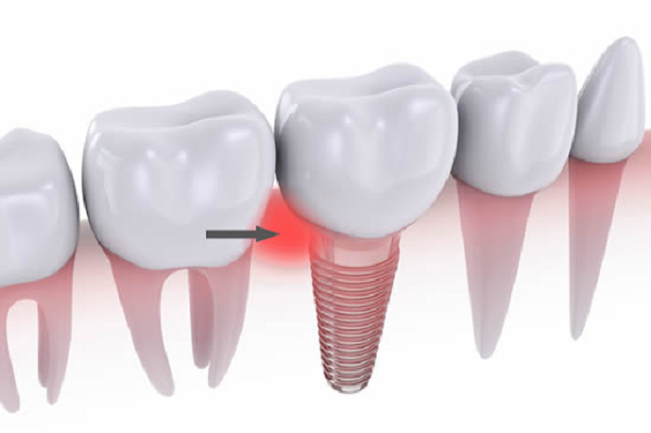 Những nguyên nhân gây viêm cho răng implant