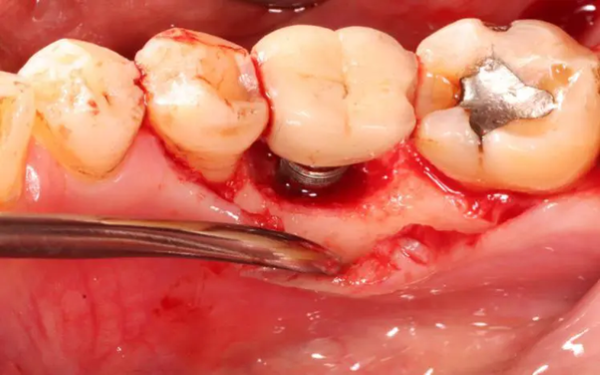 Những biểu hiện cho thấy răng implant bị viêm
