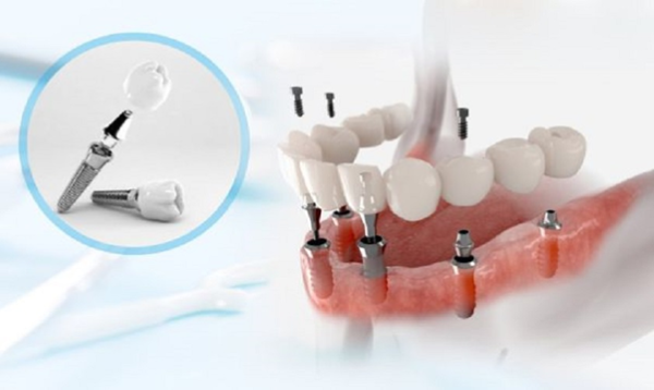 Các phương án điều trị khi bị viêm răng implant