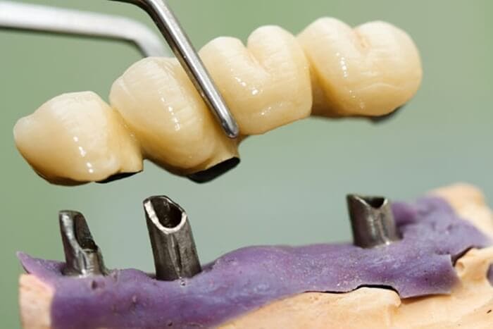 Nguyên nhân răng implant bị đào thải