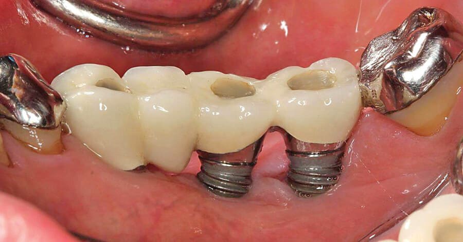 Răng implant bị đào thải