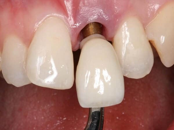 Khắc phục tình trạng răng implant bị đào thải