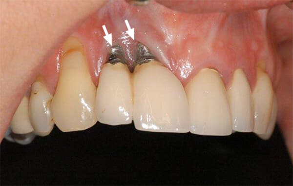 Triệu chứng của răng implant bị đào thải
