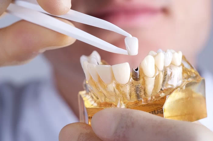Sau khi trồng răng implant thì nên ăn những gì?