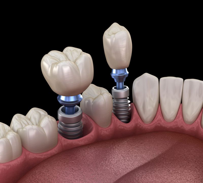 Cấu tạo của răng implant xi măng