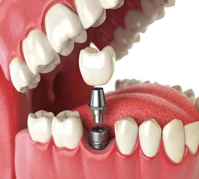 Ưu và nhược điểm của trồng răng implant xi măng