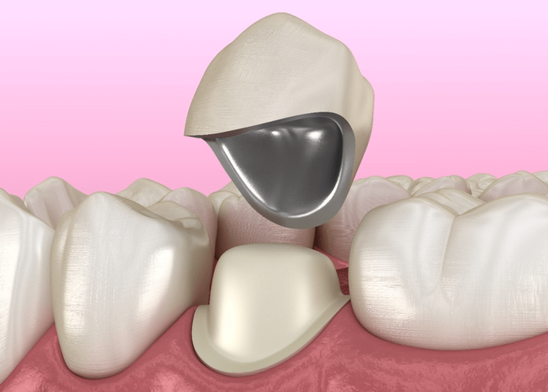 Bọc răng sứ bị cộm có bị ảnh hưởng gì không?