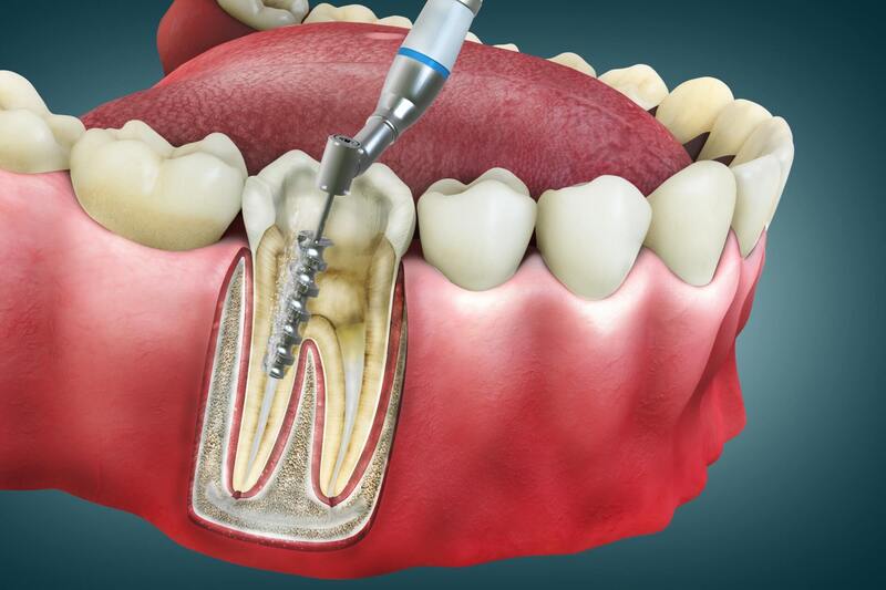 Lấy tủy răng có đau hay không?
