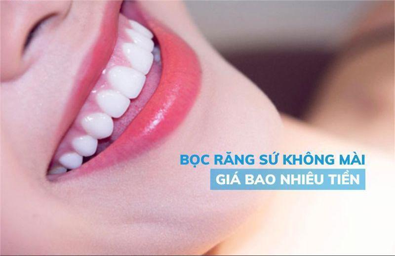 Bọc Dán Sứ Không Mài Răng Giá Bao Nhiêu?