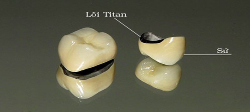 Bọc răng sứ Titan