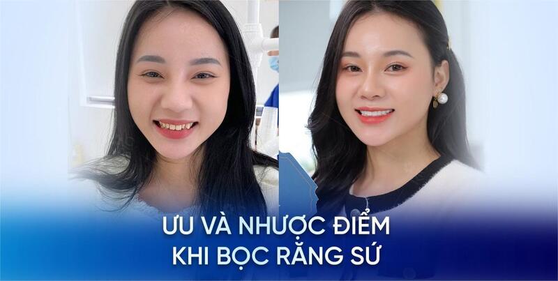 Ưu và nhược điểm của bọc răng sứ cho răng hô