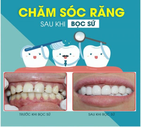 Răng hô bọc sứ có nên không? Quy trình làm răng hô bọc sứ