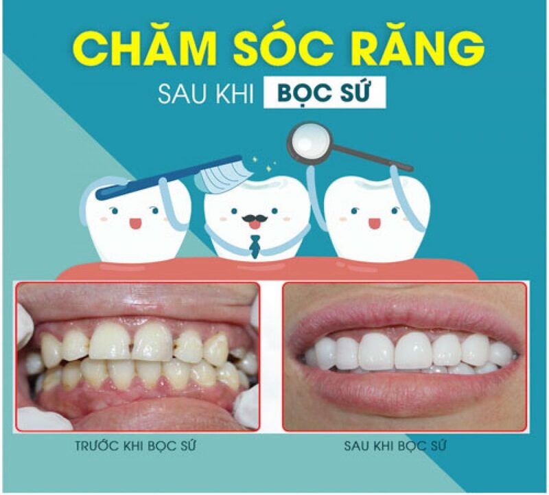 Chăm sóc sau khi bọc răng sứ cho răng hô