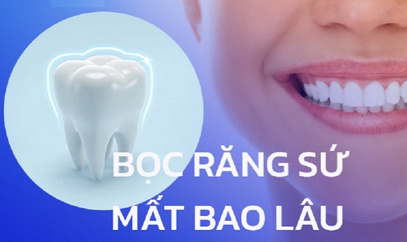 Bọc răng sứ cho răng mọc lệch mất bao lâu?