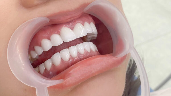 Gây ra các vấn đề về sức khỏe răng miệng