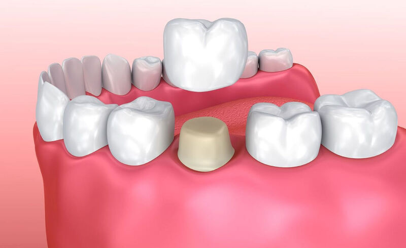 Lợi ích khi bọc răng sứ nguyên hàm là gì?