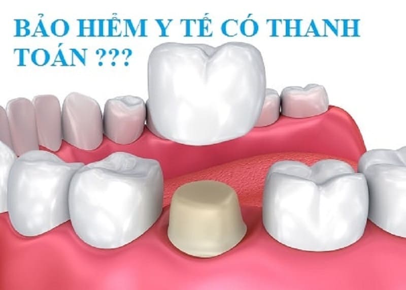 Bảo hiểm y tế có chi trả cho dịch vụ bọc răng sứ không?