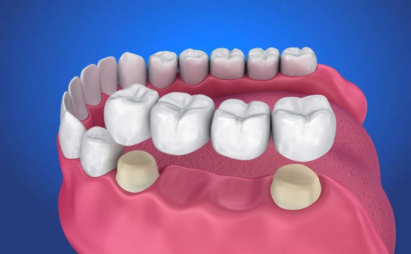 Dịch vụ trồng răng Implant thay cho cầu răng sứ răng cửa tại Nha khoa Cường Nhân