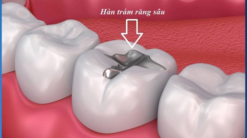 Tổng quan về hàn răng sâu