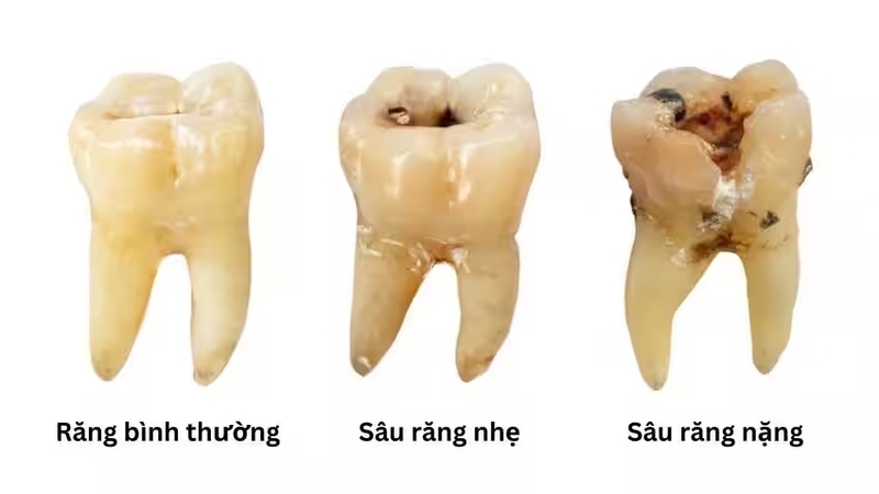 Nguyên nhân gây ra tình trạng răng bị sâu ăn mòn