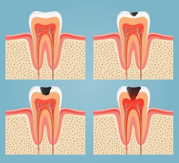 Cần nhận biết tình trạng sâu răng đang ở mức độ nào