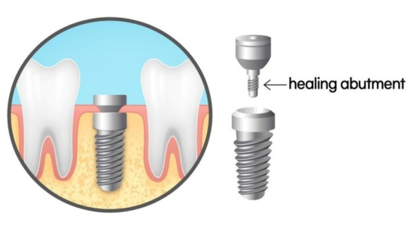 Những Đặc Điểm Của Healing Abutment