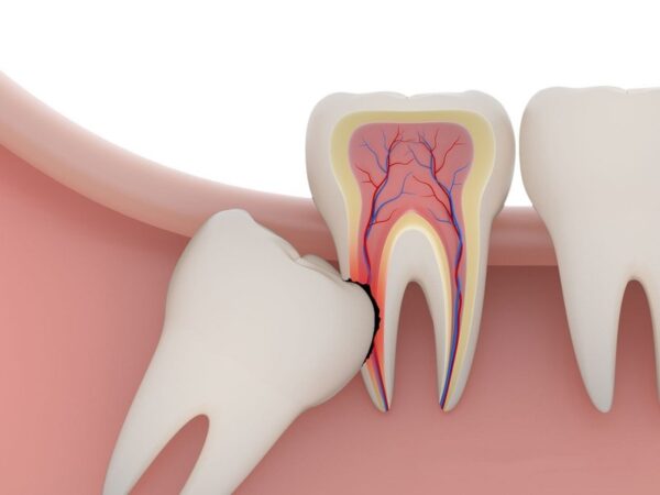 Răng số 8 nằm ở đâu trên cung hàm ?