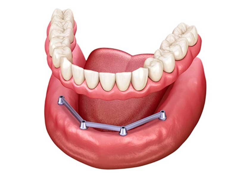 Cấu tạo và đặc điểm nổi bật của thanh bar trên implant