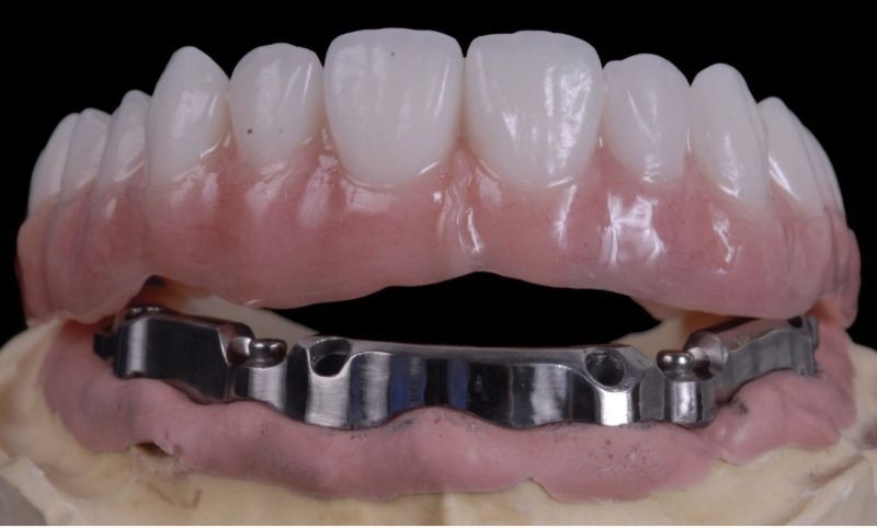 Thời điểm thích hợp để sử dụng thanh bar trên Implant