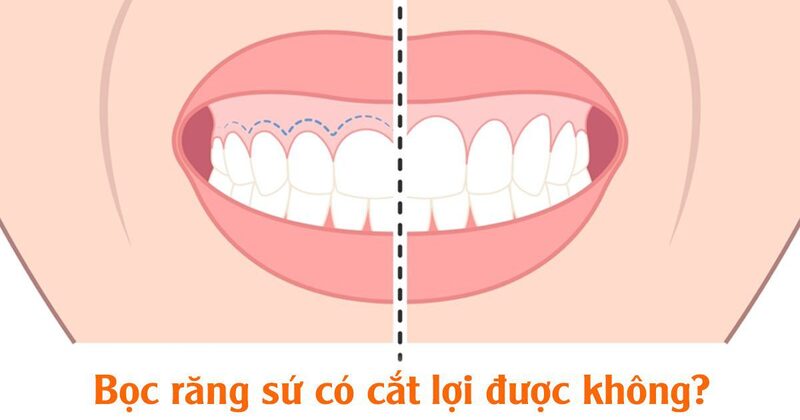 Trả lời - bọc răng sứ có cắt lợi được không ?