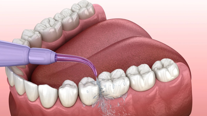 Lợi ích của tăm nước cho răng miệng