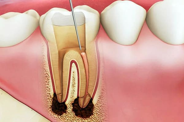 Khi nào cần lấy tủy răng trước khi bọc răng sứ?