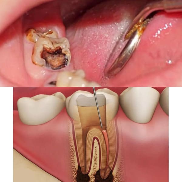 Vì sao cần bọc răng sứ sau khi lấy tủy?