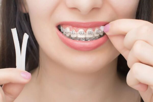 Sáp nha khoa là gì ? Cách sử dụng sáp nha khoa đúng chuẩn y khoa