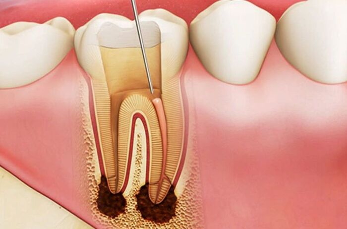 Phương pháp điều trị tủy răng