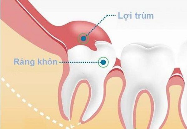 Biến chứng và các dấu hiệu viêm lợi trùm răng khôn