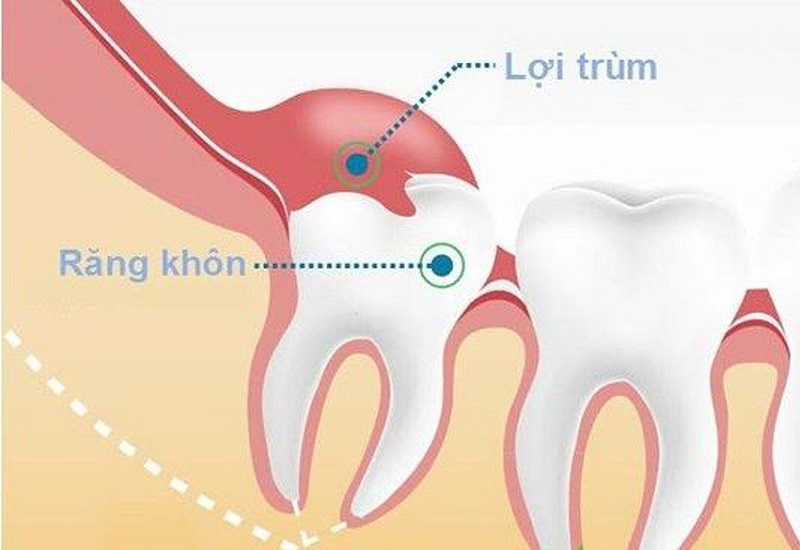 Viêm lợi trùm răng khôn là hiện tượng gì?