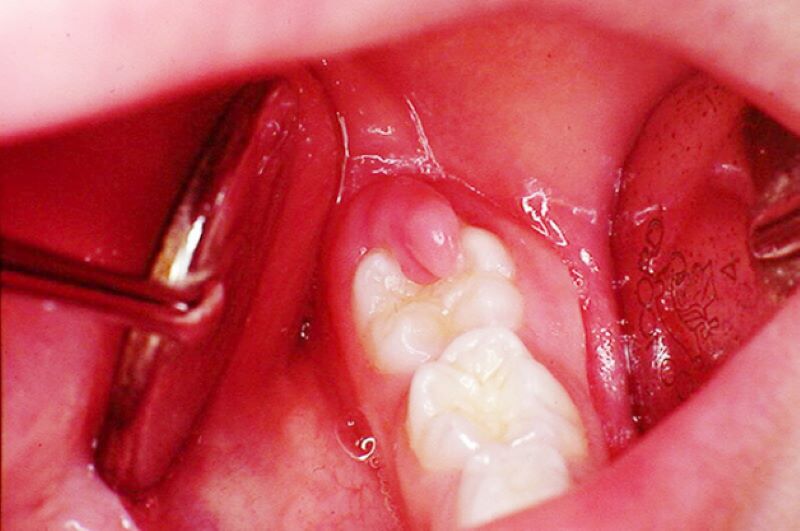 Chảy máu và đau răng khi bị viêm lợi
