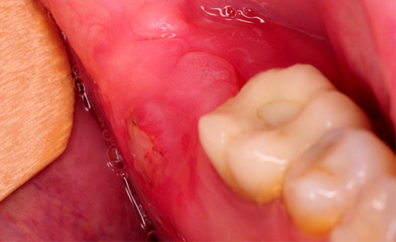 Các biến chứng viêm lợi trùm răng khôn