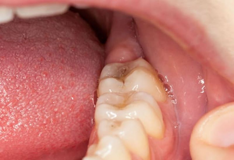 Cách điều trị viêm lợi trùm răng khôn