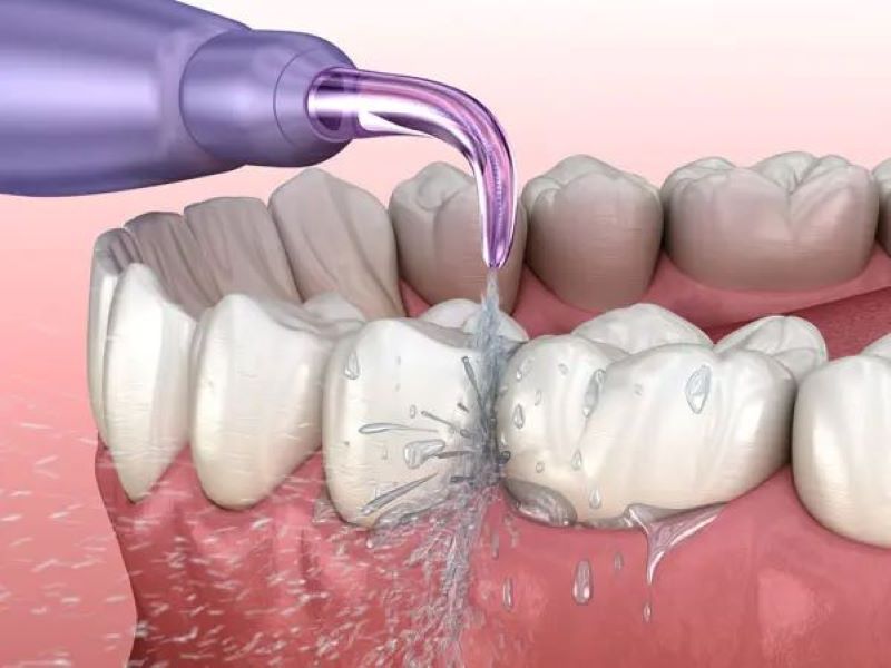 Máy tăm nước có lấy được cao răng không