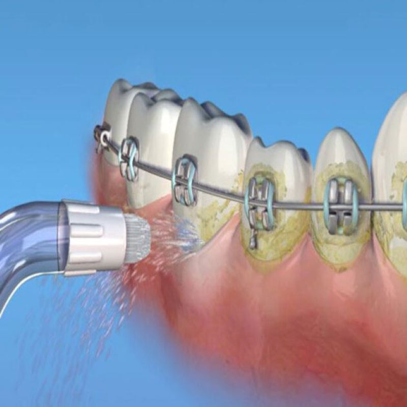 Máy tăm nước không thể làm sạch cao răng đã hình thành