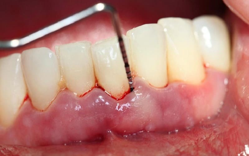 Những lý do bạn bị viêm chân răng