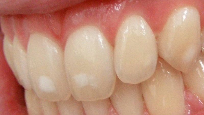 Các nguyên nhân xuất hiện đống trắng răng