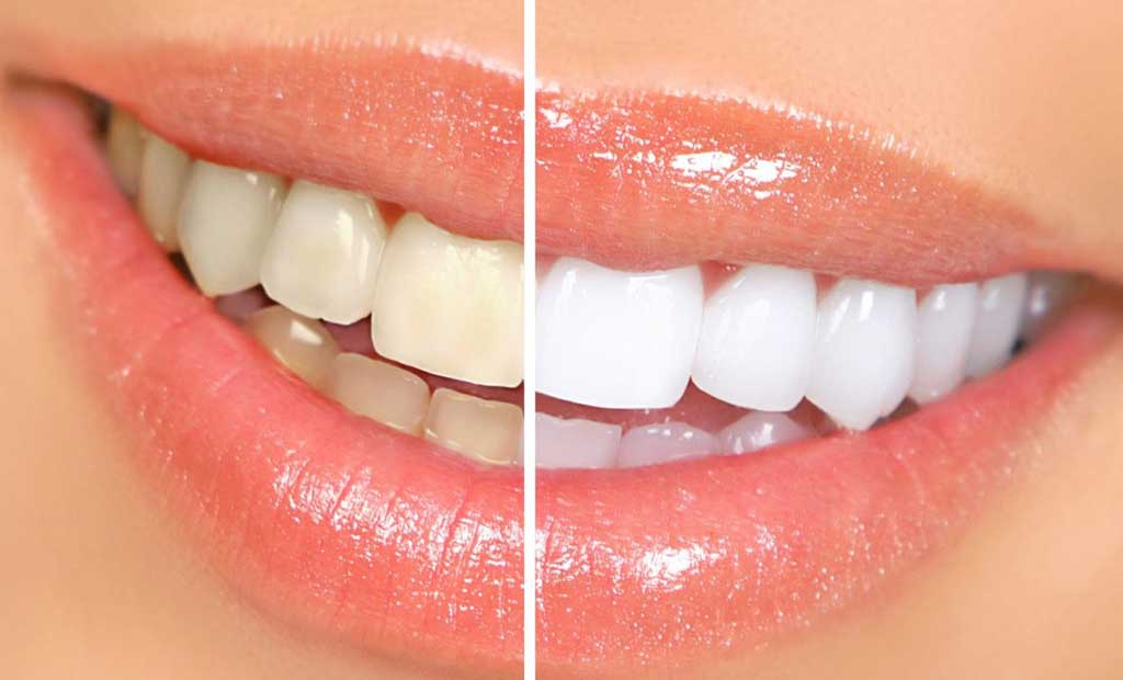 Răng bị đốm trắng nhờ tẩy trắng răng