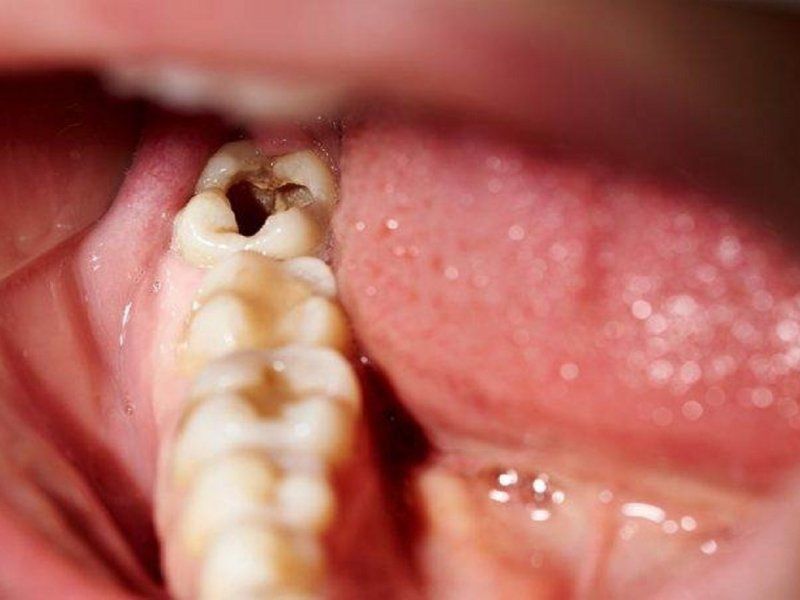 Răng bị sâu lỗ to phải làm gì?